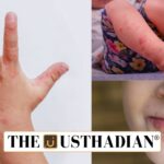 Hand Foot and Mouth Disease Cases Rise in Children