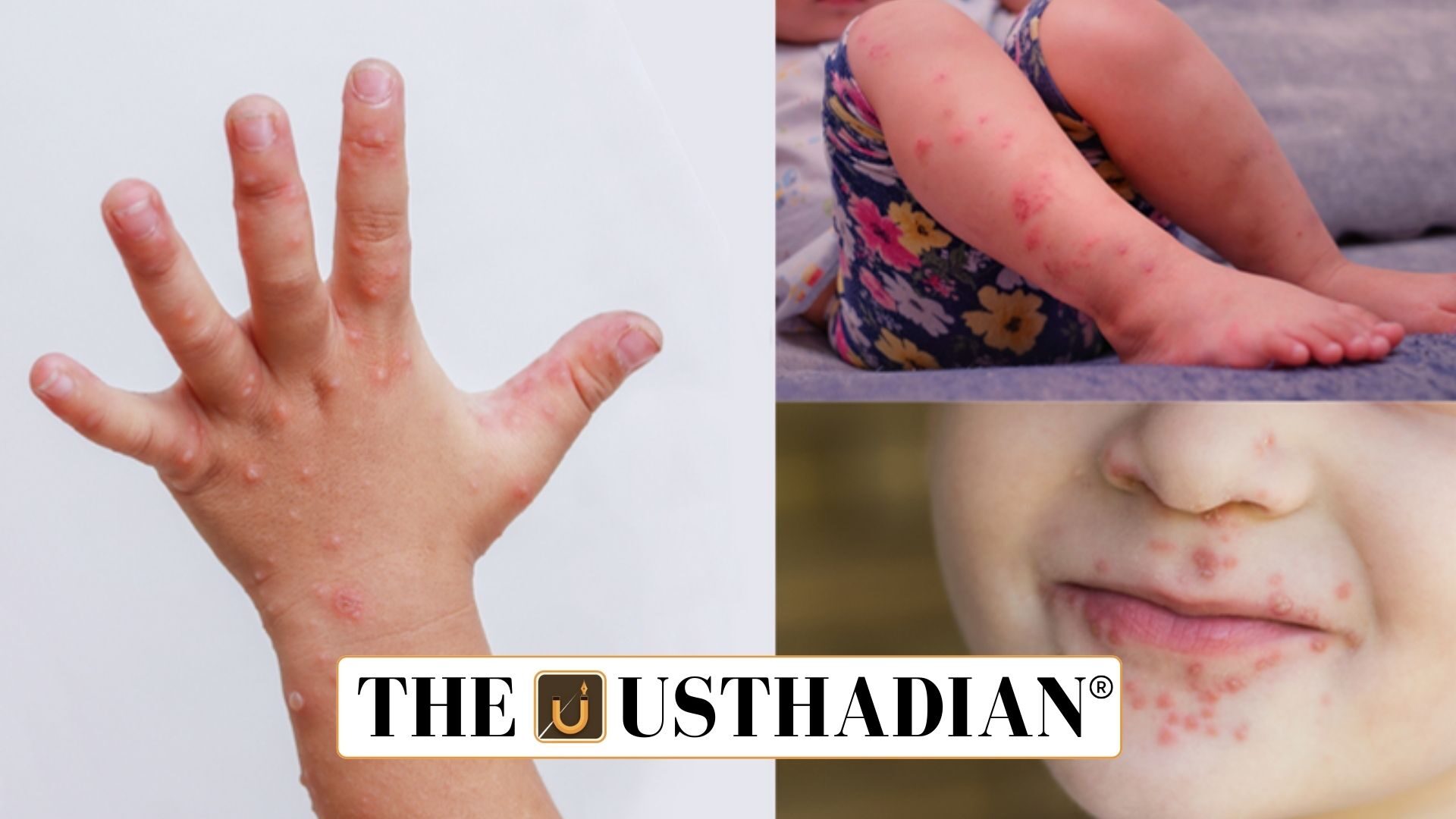 Hand Foot and Mouth Disease Cases Rise in Children