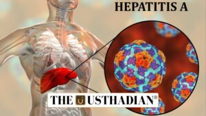 Rise of Hepatitis A Cases in India